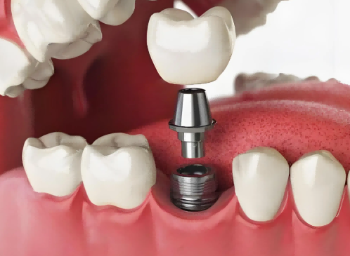 單顆/多顆種植牙、即刻種植